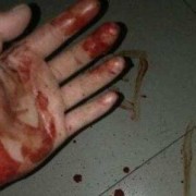 孕期鼻子出血（孕期鼻子出血怎么回事正常吗）