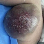 先天性血管畸形能彻底治好吗,胎儿畸形的10大征兆