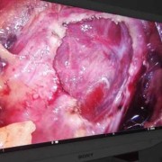 胎儿腹腔囊肿手术费用多少,胎儿腹腔囊肿怎么回事啊