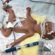 34周出生的早产儿,34周胎儿早产严重吗