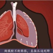 胎儿胸腔积液怎么办（胎儿胸腔积液怎么办,能要吗）