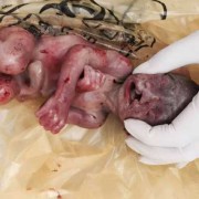 四维彩超兔唇怎么办,胎儿唇腭裂四维图片大全