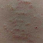 孕期后背痒（孕期后背痒怎么回事）