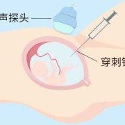 胎儿羊水穿刺（孕妇做羊水穿刺有多大风险）