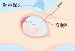 胎儿羊水穿刺（孕妇做羊水穿刺有多大风险）