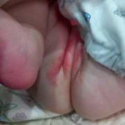 孕期臀部湿疹（小儿屁股湿疹）