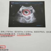 阴超会对宝宝有影响吗,怀孕了做阴超对胎儿有影响吗