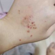 孕妇湿疹很严重怎么办呢,孕期全身湿疹怎么办啊