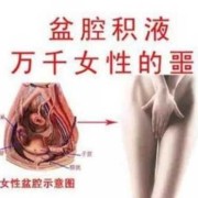 孕期盆腔积液（孕期盆腔积液）