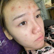 怀孕期间脸上长痘痘怎么办,怀孕期间脸上长痘痘怎么办