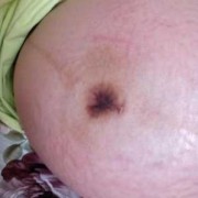 孕期肚脐眼周围变黑了（孕期肚脐眼周围变黑了）