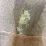 整个孕期都有霉菌（整个孕期都有霉菌会不会影响胎儿）