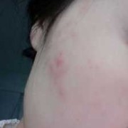 孕期为什么长痘痘（怀孕起痘痘）