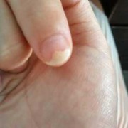 指甲空的厉害,孕期指甲空了一半不连着肉