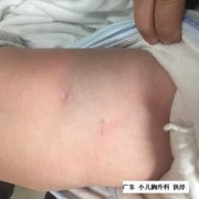 先天性肺囊腺瘤会变小吗,胎儿左肺囊腺瘤怎么办能治好吗