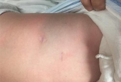 先天性肺囊腺瘤会变小吗,胎儿左肺囊腺瘤怎么办能治好吗