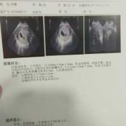 怀孕有9周了，产检结果见微弱原始心管搏动，这是什么意思,胎儿先心病是什么原因引起的