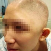 胎儿颅骨缺失会长好吗（颅骨缺损属于几级伤残）