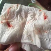 孕期鼻涕带血是什么原因（孕妇感冒流鼻涕怎么办呢）