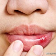 孕期嘴唇起泡（怀孕嘴巴上火，舌头起泡怎么办）