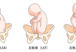胎儿lsa（胎儿lsa）