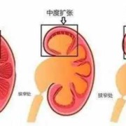 怀孕宝宝肾积水是什么原因,胎儿肾结水是什么原因引起的