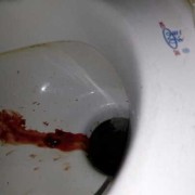 孕期出血怎么办（孕妇大便出血怎么办）