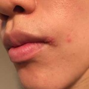 孕期嘴疱疹（嘴上长疱疹怎么回事）