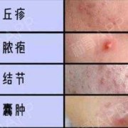 怀孕脸上长痘痘是什么原因,孕期脸上长痘痘是什么原因导致的