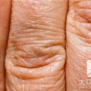孕期乳头皴裂（产妇乳头皲裂怎么办）