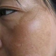 妊娠斑如何治疗,孕期长黄褐斑什么原因