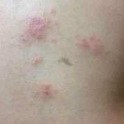 孕期背痒（身上后背出现痒是怎么回事，如何处理的）