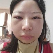 眼睛浮肿是什么原因?吃什么药才好呢,孕期眼睛浮肿是什么原因