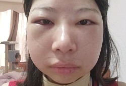 眼睛浮肿是什么原因?吃什么药才好呢,孕期眼睛浮肿是什么原因