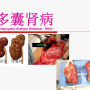右肾多囊的胎儿能要吗（右肾多囊的胎儿能要吗女性）