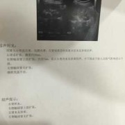 胎儿右肾轻度积水（胎儿右肾轻度积水是什么意思）