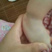 宝宝手背脚背上有胎青,胎儿的胎记是怎么造成的