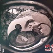 婴儿做磁共振怎么做,胎儿脑核磁共振能检查出什么