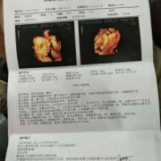 胎儿系统超声检查是检查什么的,胎儿心脏超声筛查是四维吗