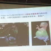 巨膀胱胎儿 原因（巨膀胱胎儿 原因）