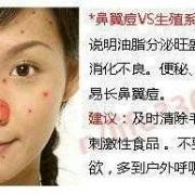 孕期鼻子长痘（孕期鼻子长痘痘是什么原因）
