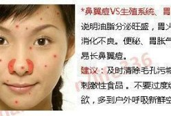 孕期鼻子长痘（孕期鼻子长痘痘是什么原因）