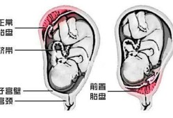 胎盘前壁和后壁胎儿图（胎盘前壁和后壁胎儿图片对比）