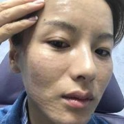 备孕期可以打水光针吗（备孕期可以打水光针吗女性）