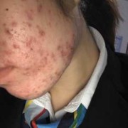 怀孕脸上长痘痘是什么原因,孕期脸上长痘痘是什么原因导致的