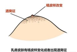 孕期乳头痒怎么缓解（怀孕期间乳头痒怎么回事）
