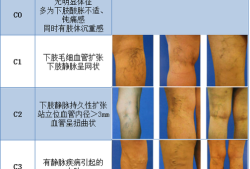 孕期腿部静脉曲张怎么办（孕期静脉曲张能顺产吗）
