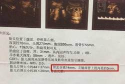 胎儿双肾盂分离知男女（胎儿双肾盂分离男女比例）