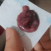 怀孕出血影响胎儿吗（怀孕出血影响胎儿吗）