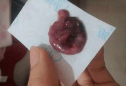 怀孕出血影响胎儿吗（怀孕出血影响胎儿吗）